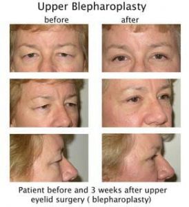 Upper Blepharoplasty