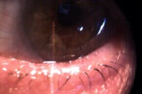 Eyelid After Plastic Surgery