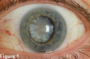 Crystalline lens of the eye - Eye care clinic in Virginia Beach, VA