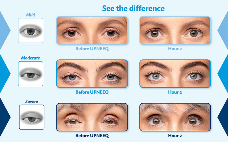 Droopy Eyelids Causes Treatments Risks More Howard Ossen Od